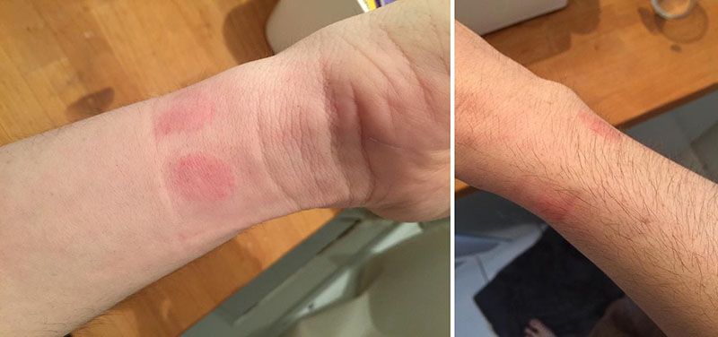 Apple Watch: alcuni cinturini provocano irritazioni ai polsi ma Apple dà la colpa agli utenti!