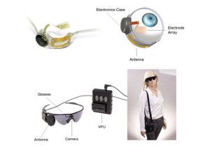 Argus_ii_Implant_External