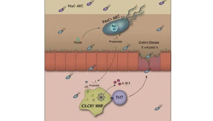 Morbo di Crohn