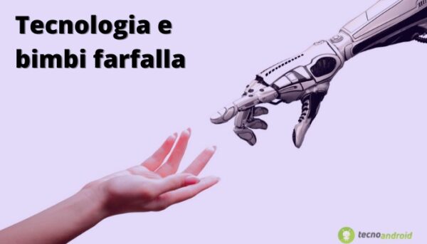 Mano mioelettrica: la tecnologia ha regalato al "bimbo farfalla" un nuovo arto