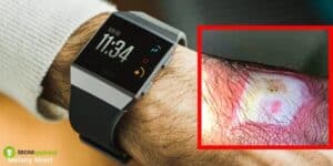Fitbit: orologi richiamati dal mercato, possono provocare ustioni