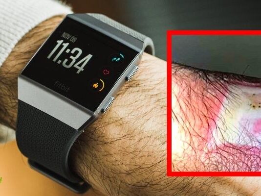 Fitbit: orologi richiamati dal mercato, possono provocare ustioni