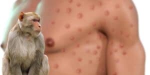 Monkeypox