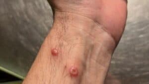 Vaiolo delle scimmie: possibile quarantena, sta per arrivare già il vaccino con due dosi