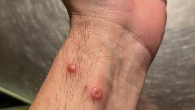 Vaiolo delle scimmie: possibile quarantena, sta per arrivare già il vaccino con due dosi