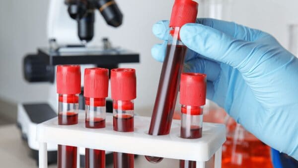 Presto i prelievi del sangue avverranno senza aghi?