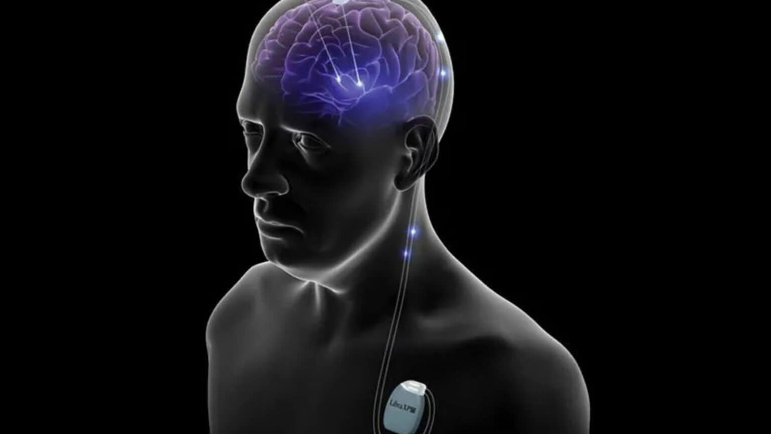 Microchip contro il Parkinson, il paziente italiano sta bene