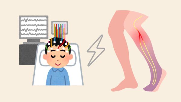 Un team di ricercatori sta testando una nuova tecnica basata sulla stimolazione cerebrale profonda, o DBS, per i pazienti con paralisi.