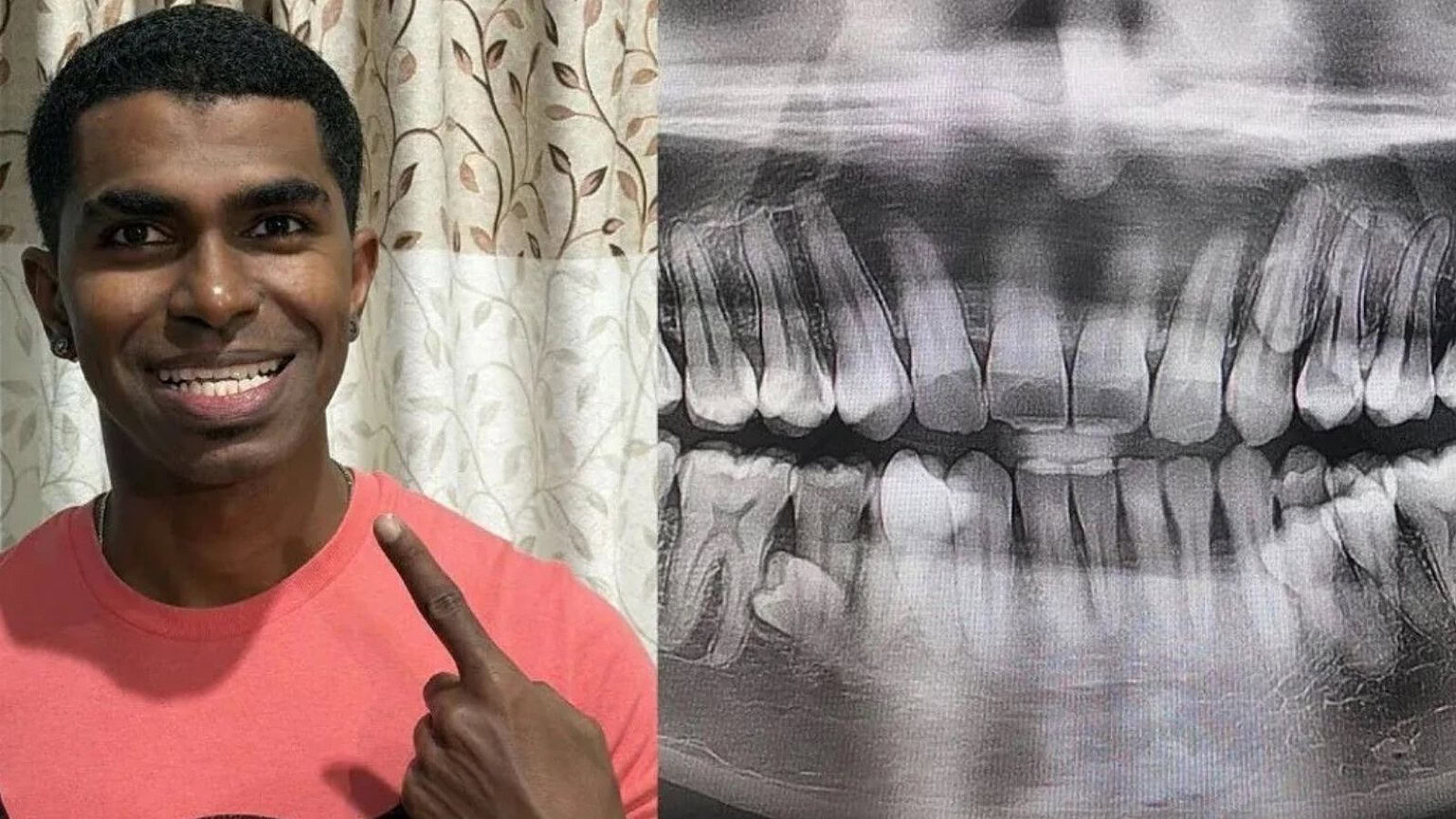 Uomo con 42 denti: non sapeva di averli tutti, cosa dice la medicina