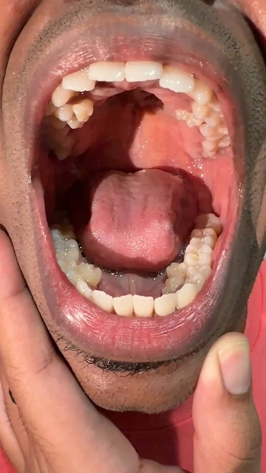iperdonzia uomo con 42 denti