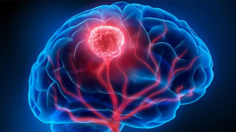 Tumore al cervello: scoperta rivoluzionaria per combattere il Glioblastoma