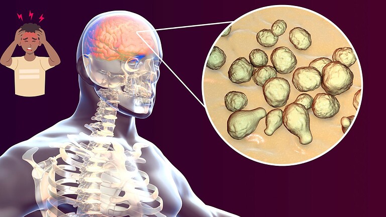 Meningite B nel Regno Unito: focolaio record, cosa sta succedendo