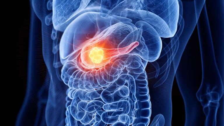 Tumore al pancreas, come funziona la nuova molecola che combatte il cancro