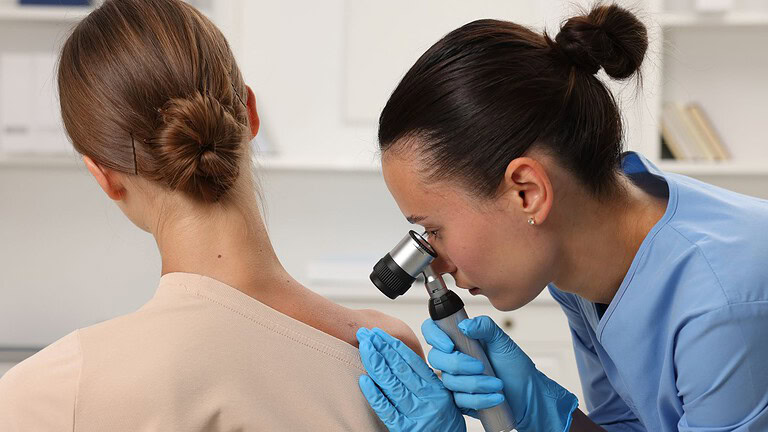 cerotto melanoma