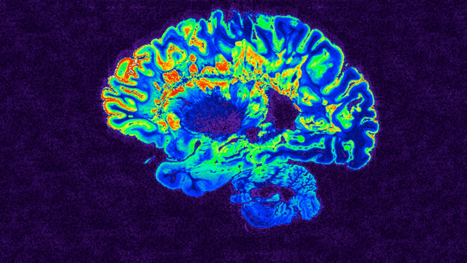 Sclerosi multipla: la scoperta che cambia tutto sulla morte dei neuroni - sclerosi multipla neuroni