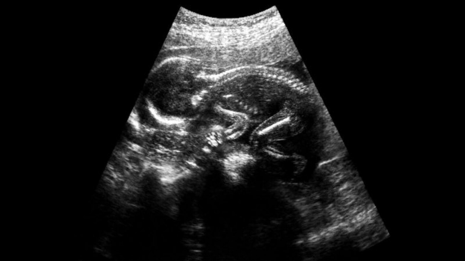 Spina bifida: cellule staminali in chirurgia prenatale, primi risultati - spina bifida cellule staminali
