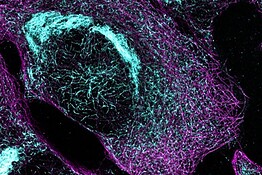 Alzheimer, un esame del sangue potrebbe sostituire le costose scansioni cerebrali