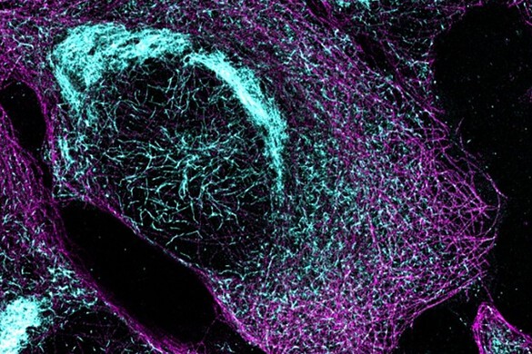 Alzheimer, un esame del sangue potrebbe sostituire le costose scansioni cerebrali