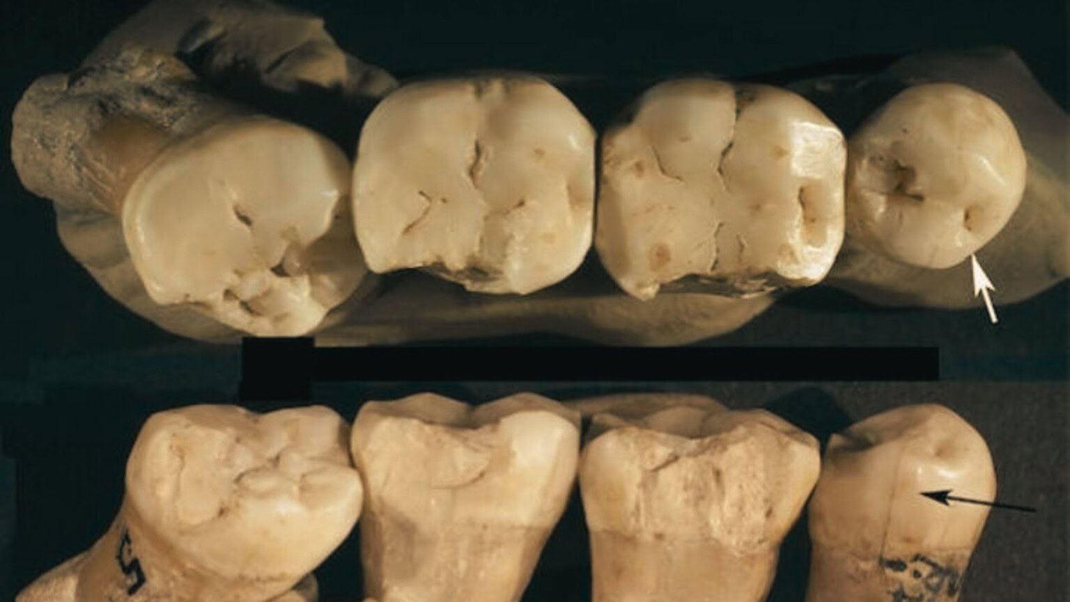 chirurgia dentale Neanderthal