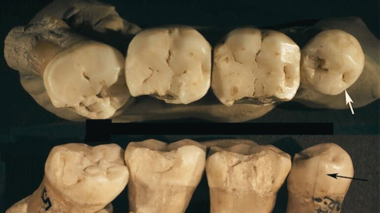 chirurgia dentale Neanderthal