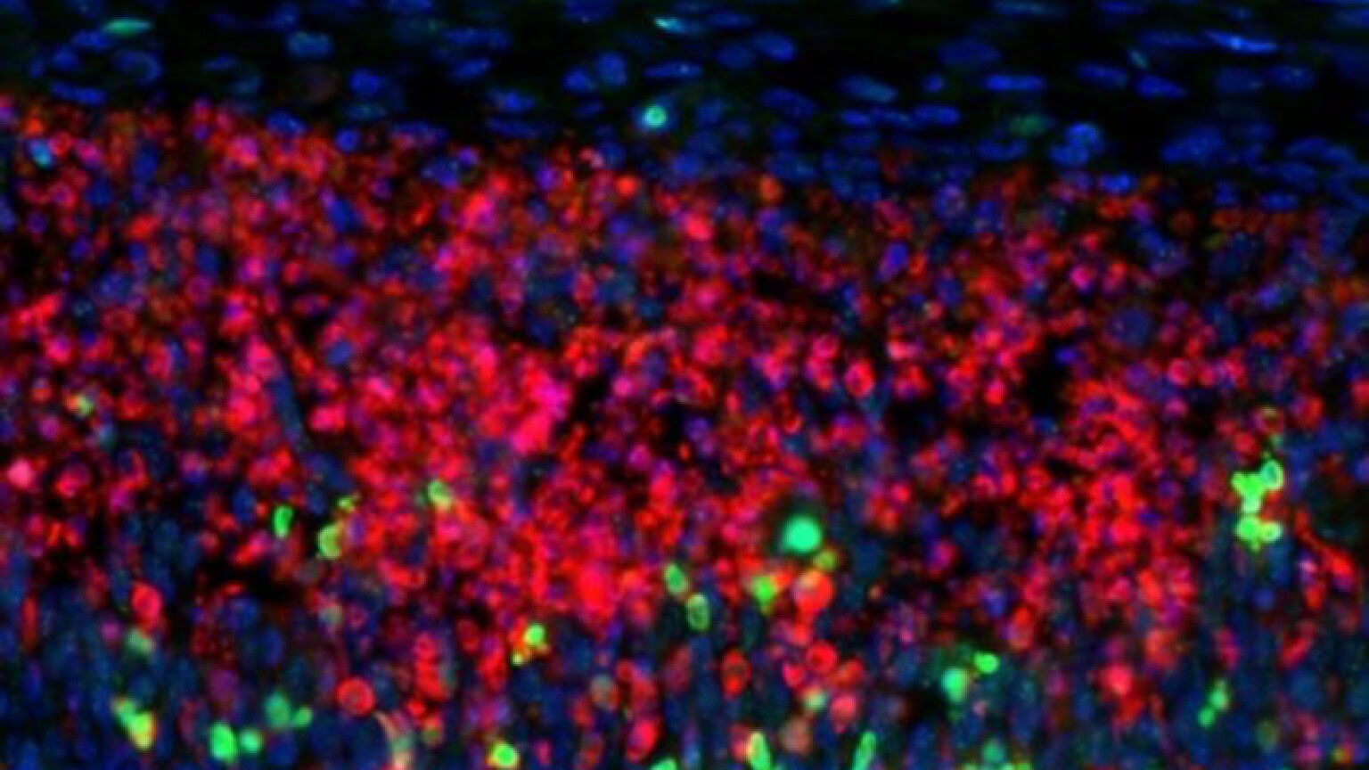 Sclerosi multipla: ecco perché alcune cellule cerebrali cedono prima - sclerosi multipla cellule cerebrali
