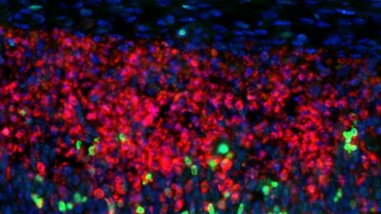 Sclerosi multipla: ecco perché alcune cellule cerebrali cedono prima - sclerosi multipla cellule cerebrali