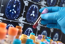 Esame del sangue per la demenza: l’AI scopre le forme sovrapposte