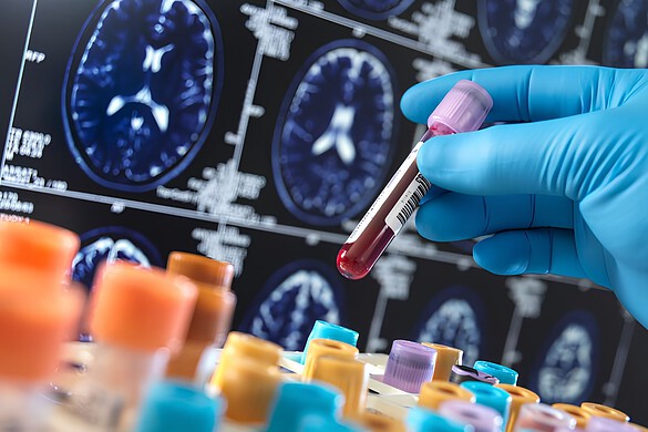 Esame del sangue per la demenza: l’AI scopre le forme sovrapposte