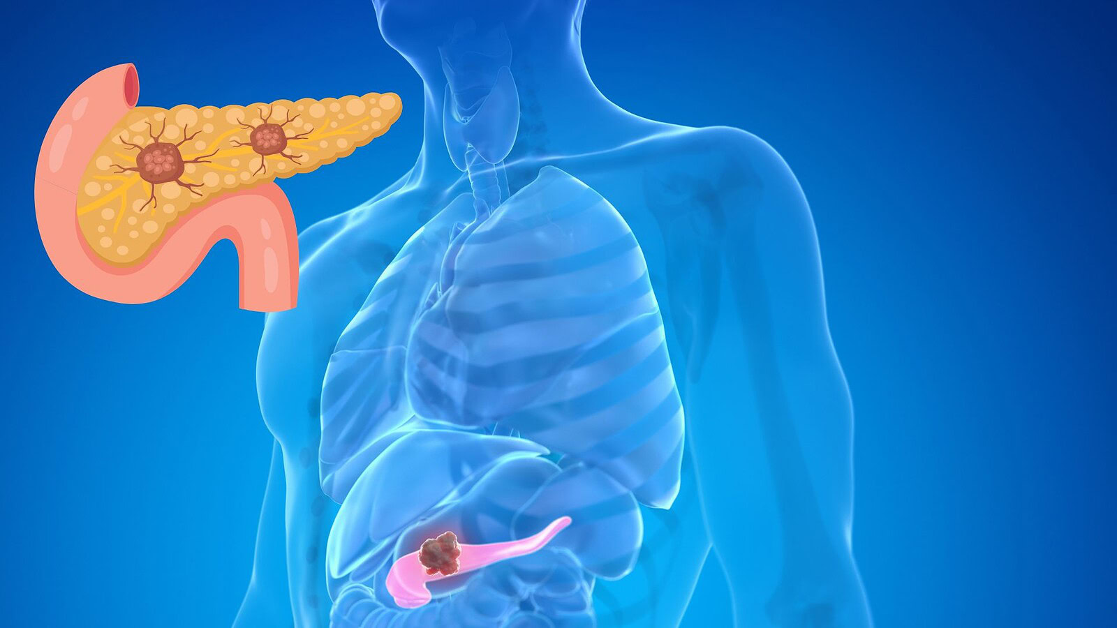 Tumore al pancreas, una nuova molecola raddoppia la sopravvivenza