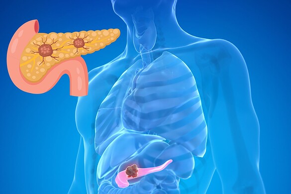 Tumore al pancreas, una nuova molecola raddoppia la sopravvivenza