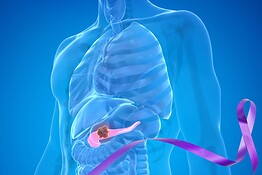 Tumore al pancreas, daraxonrasib raddoppia la sopravvivenza dei pazienti