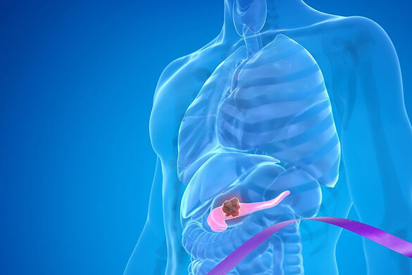 Tumore al pancreas, daraxonrasib raddoppia la sopravvivenza dei pazienti