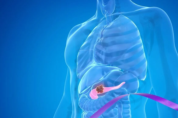 Tumore al pancreas, daraxonrasib raddoppia la sopravvivenza dei pazienti