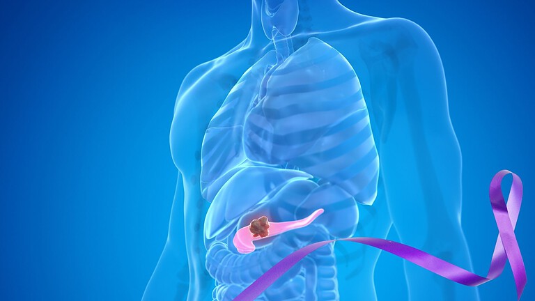 Tumore al pancreas, daraxonrasib raddoppia la sopravvivenza dei pazienti