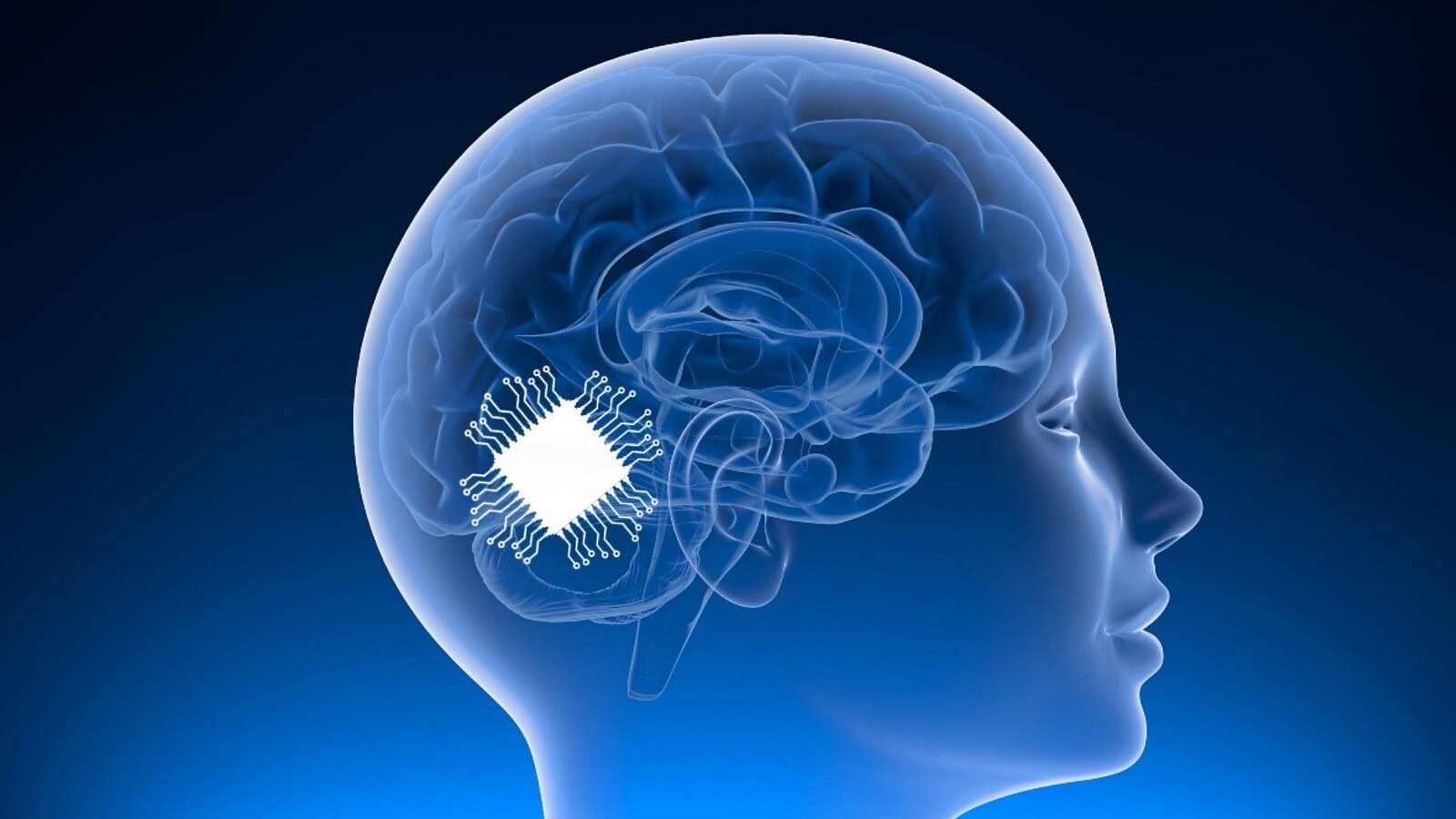 Chip nel cervello restituisce la voce ai pazienti con SLA: lo studio