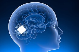 Chip nel cervello restituisce la voce ai pazienti con SLA: lo studio