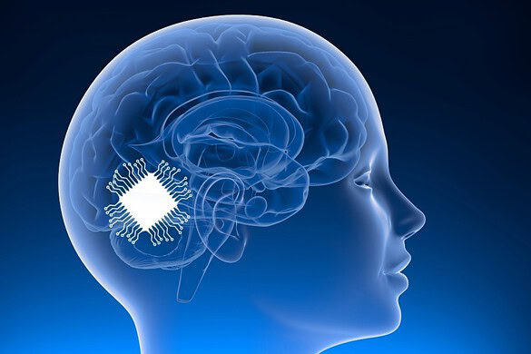 Chip nel cervello restituisce la voce ai pazienti con SLA: lo studio