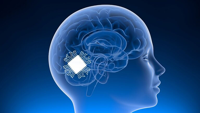Chip nel cervello restituisce la voce ai pazienti con SLA: lo studio