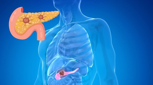 Cancro al pancreas, il farmaco che raddoppia la sopravvivenza