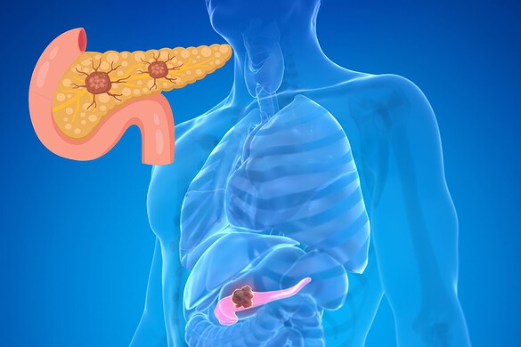 Cancro al pancreas, il farmaco che raddoppia la sopravvivenza