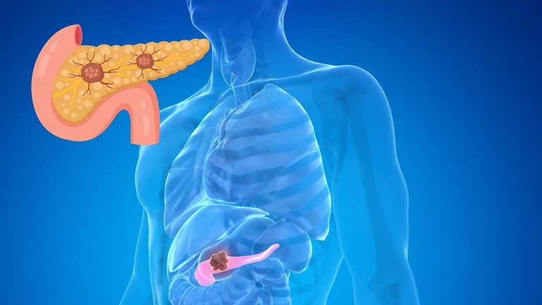 Cancro al pancreas, il farmaco che raddoppia la sopravvivenza