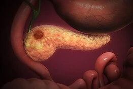 Tumore al pancreas costretto ad autodistruggersi: la nuova strategia dei ricercatori