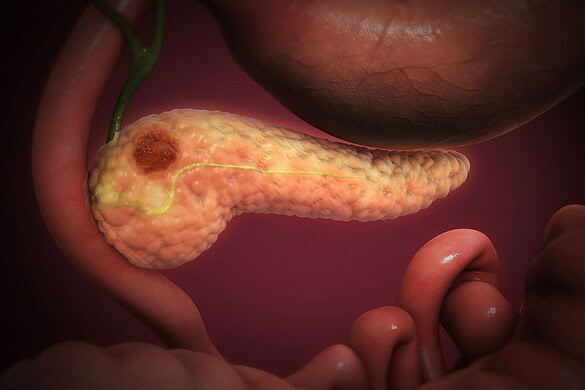 Tumore al pancreas costretto ad autodistruggersi: la nuova strategia dei ricercatori