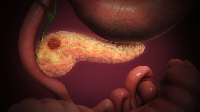 Tumore al pancreas costretto ad autodistruggersi: la nuova strategia dei ricercatori