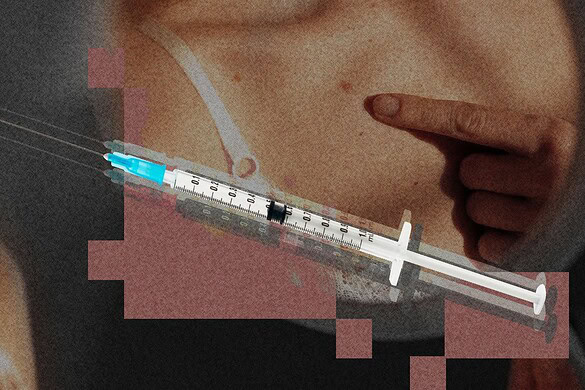 Vaccino mRNA contro il melanoma: risultati promettenti a 5 anni