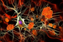 Alzheimer, la ginnastica per il cervello che funziona davvero