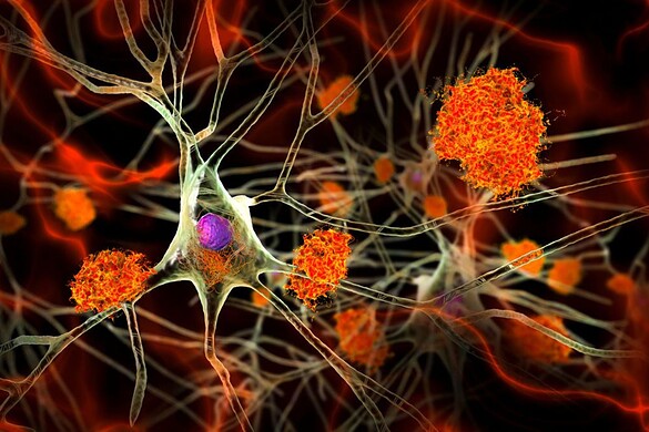 Alzheimer, la ginnastica per il cervello che funziona davvero