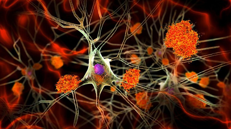Alzheimer