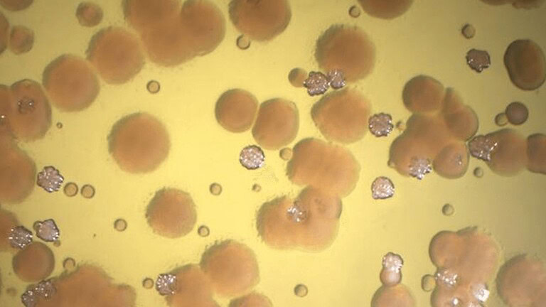 Fibrosi cistica