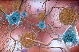 Alzheimer, nuovo farmaco anti-tau rallenta la perdita di memoria